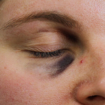 Black Eye B
