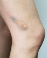 Bruises 2C