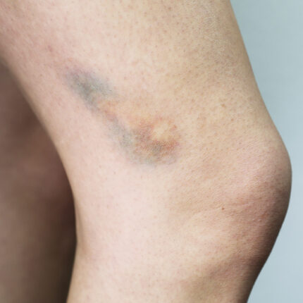 Bruises 2C