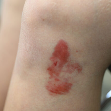 Bruises 1A