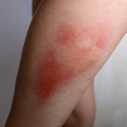 Bruises 3A