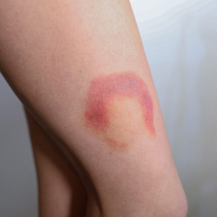 Bruises 3B