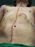 SF9 Naht (große Form)