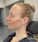 Old Age Prosthetics [Subtil] - Wangen