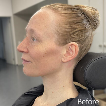 Old Age Prosthetics [Subtil] - Wangen