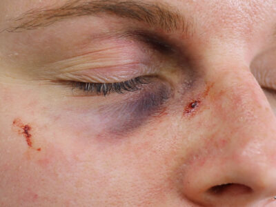 Black Eye A