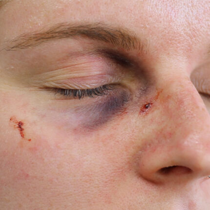 Black Eye A