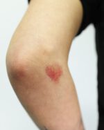 Bruises A - Fresh Bruises Set