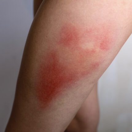 Bruises 3 Set