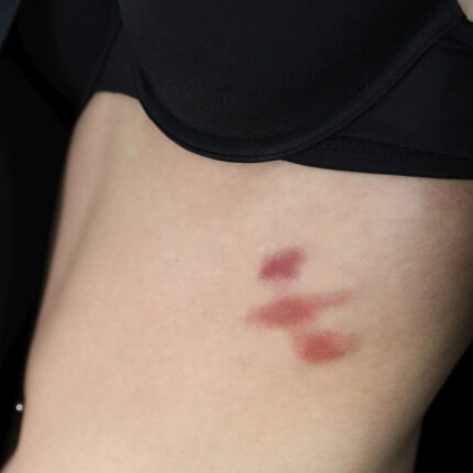 Bruises 2 Set