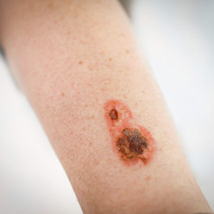 Burn Wounds