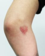 Bruises B - Slightly Aged Bruises Set