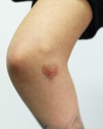 Bruises C - Final Stages Bruises Set