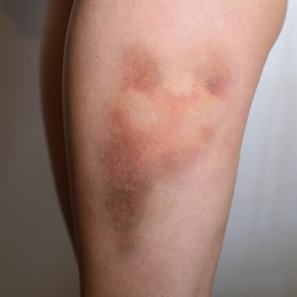 Bruises 3C