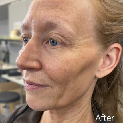 Old Age Prosthetics [Subtil] - Komplettes Set
