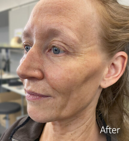 Old Age Prosthetics [Subtil] - Komplettes Set