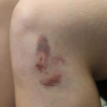 Bruises 1C