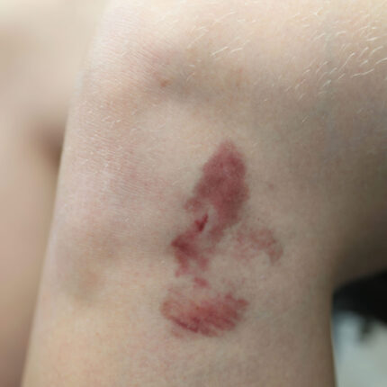 Bruises 1B