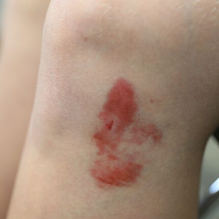 Bruises 1 Set