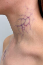 Big Vessels Veins 02
