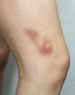 Bruises 2B