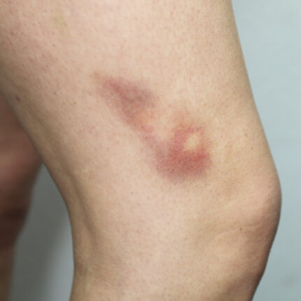 Bruises 2B