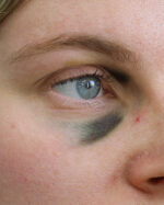 Black Eye C