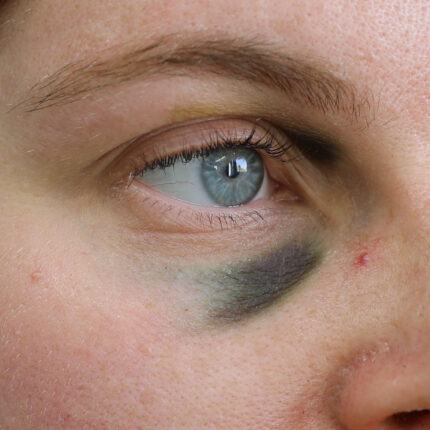Black Eye C
